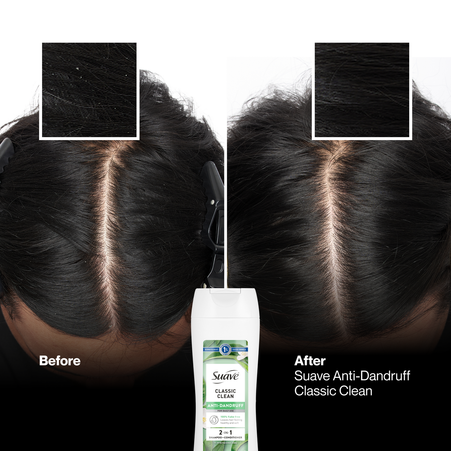 Suave Anti Dandruff 2 IN 1 Shampoo & Conditioner For Women, Classic Clean, 1% Pyrithione Zinc, Controls Flakes, Itch & Dry Scalp, 12.6 FL OZ
