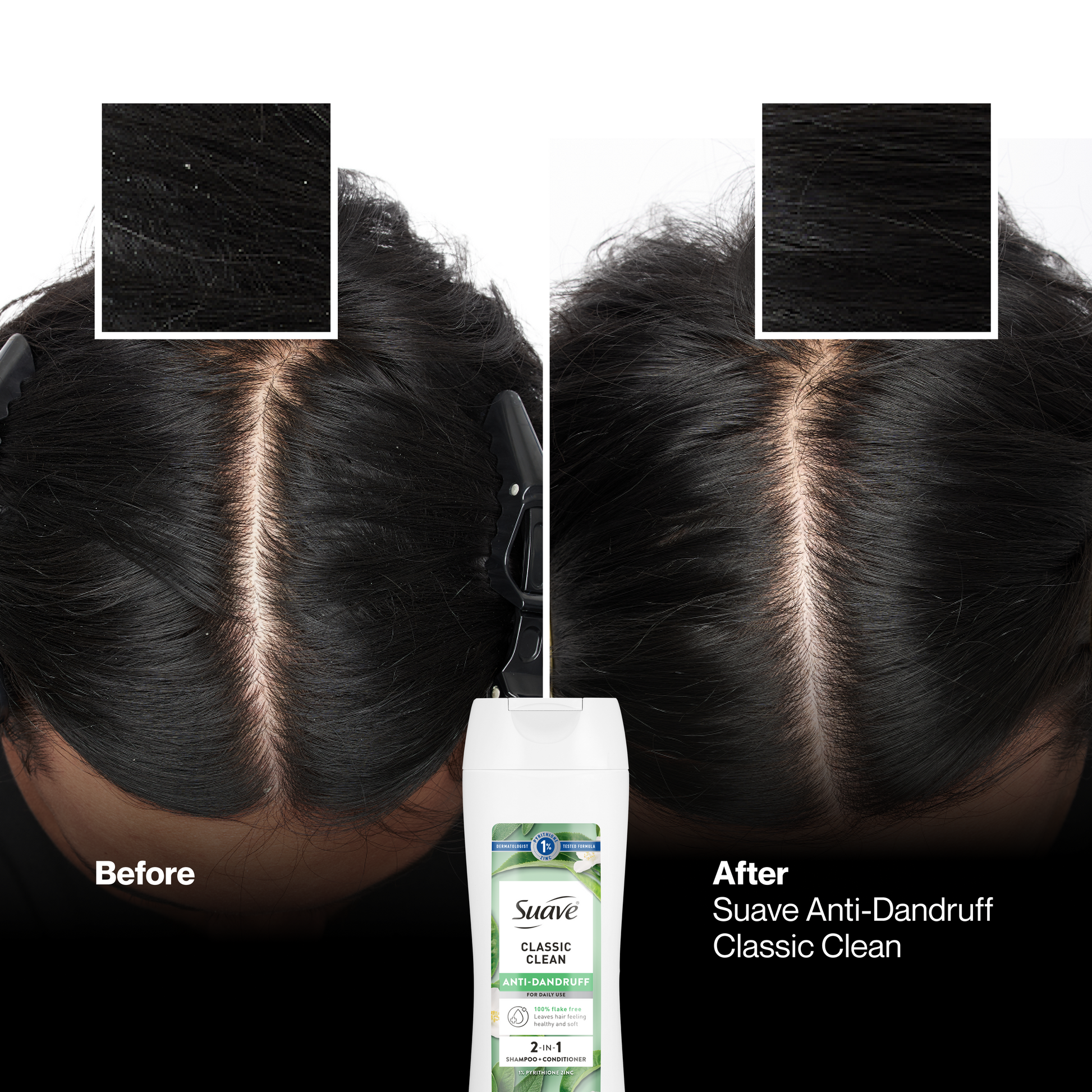 Suave Anti Dandruff 2 IN 1 Shampoo & Conditioner For Women, Classic Clean, 1% Pyrithione Zinc, Controls Flakes, Itch & Dry Scalp, 12.6 FL OZ