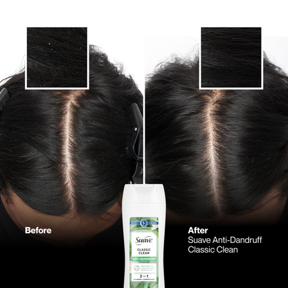 Suave Anti Dandruff 2 IN 1 Shampoo & Conditioner For Women, Classic Clean, 1% Pyrithione Zinc, Controls Flakes, Itch & Dry Scalp, 12.6 FL OZ